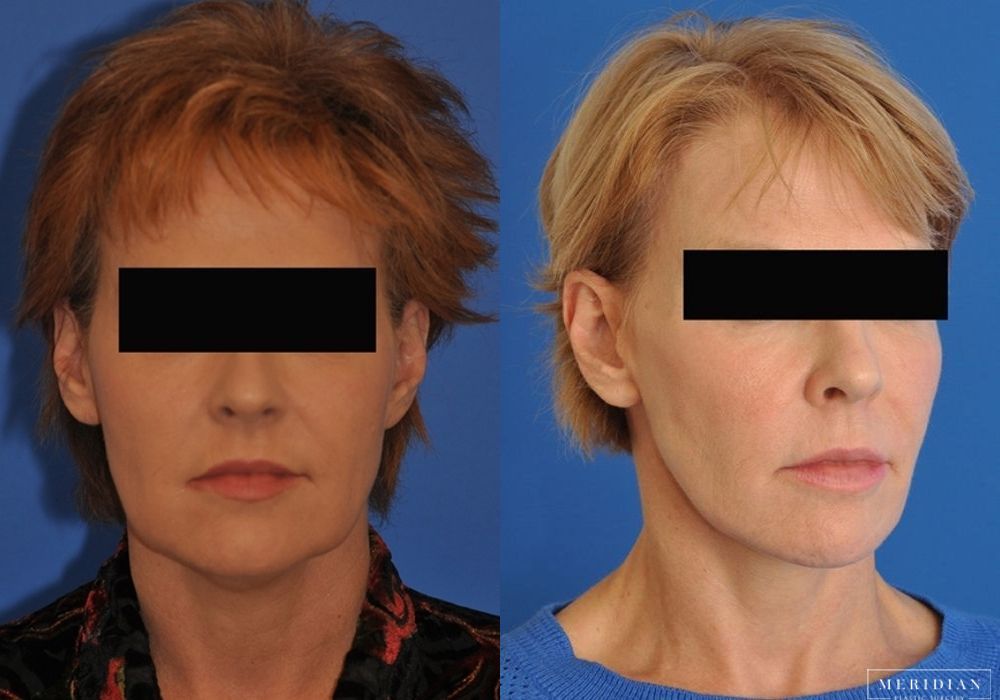 Facelift - Thumbnail 2