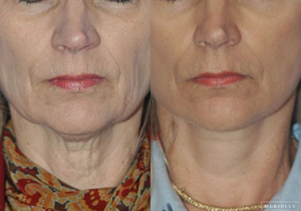 Facelift - Case 8112