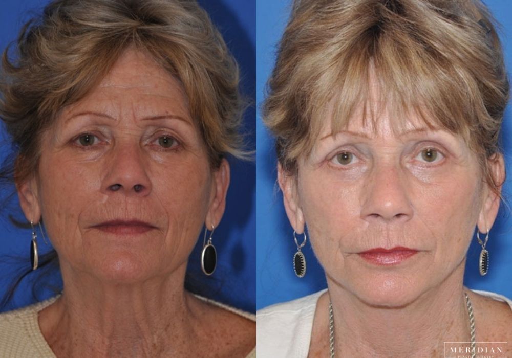 Facelift - Case 8122