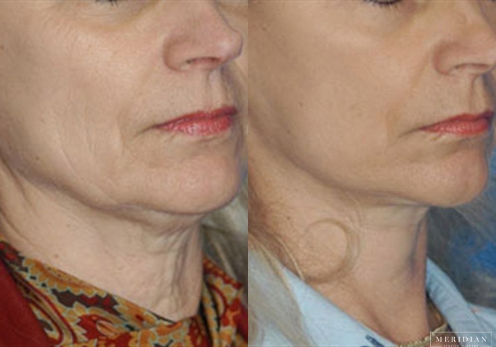 Facelift - Thumbnail 2