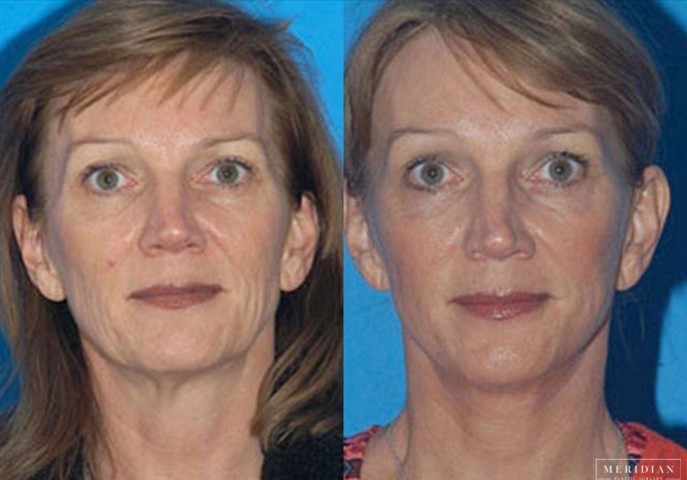 Facelift - Case 8118