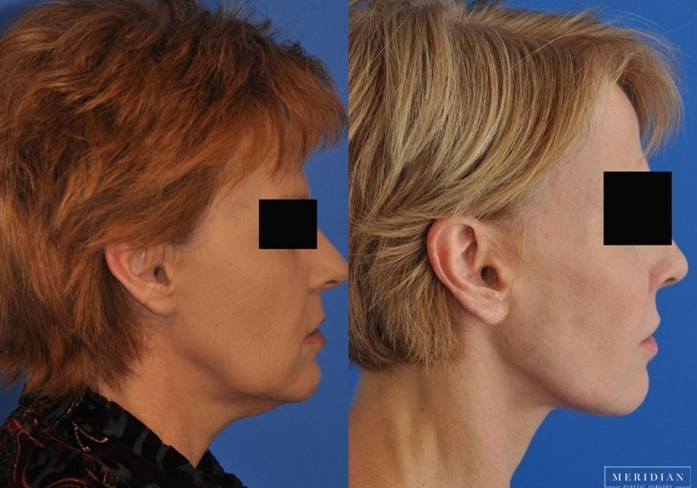 Facelift - Thumbnail 3