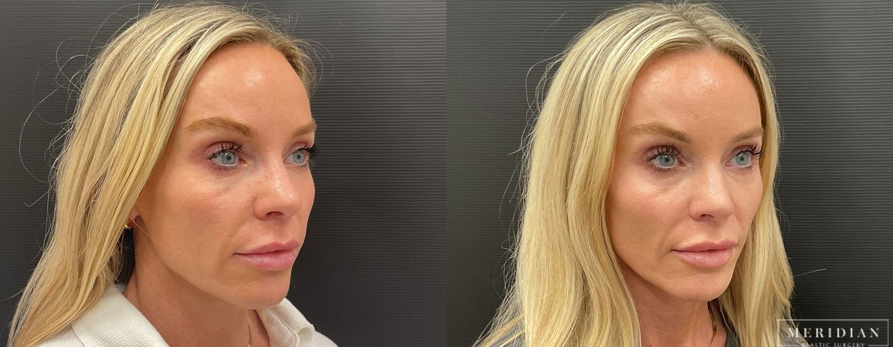 Filler - Cheeks & Lips - Thumbnail 2