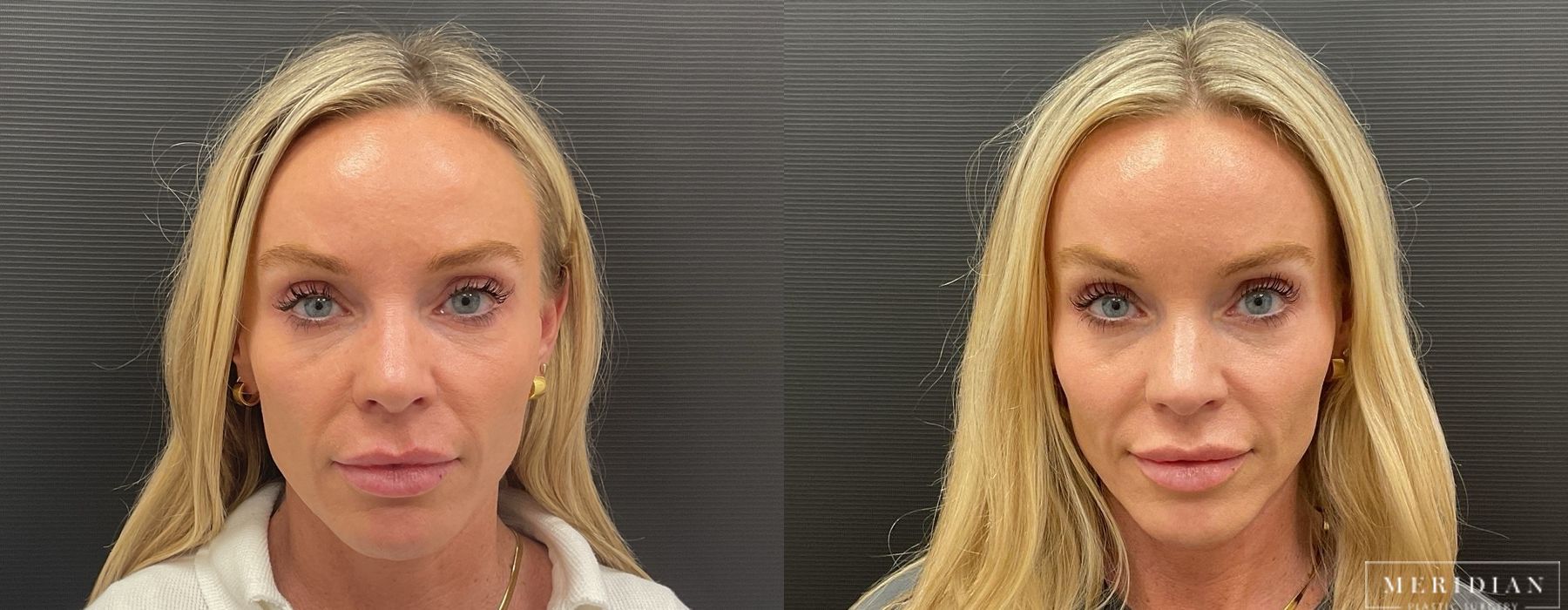 Filler - Cheeks & Lips - Case 5415