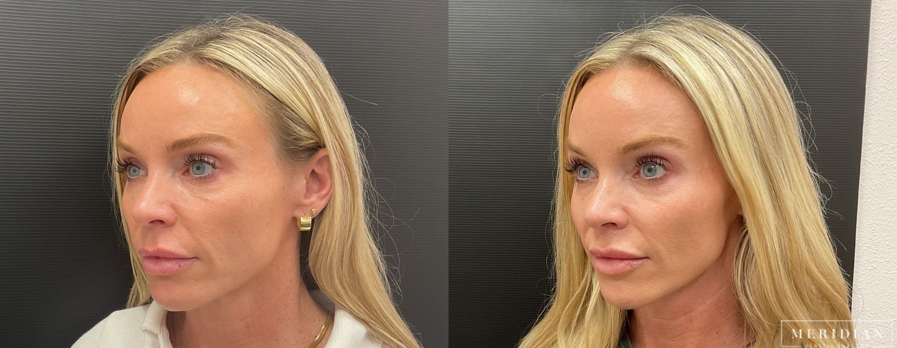 Filler - Cheeks & Lips - Thumbnail 3