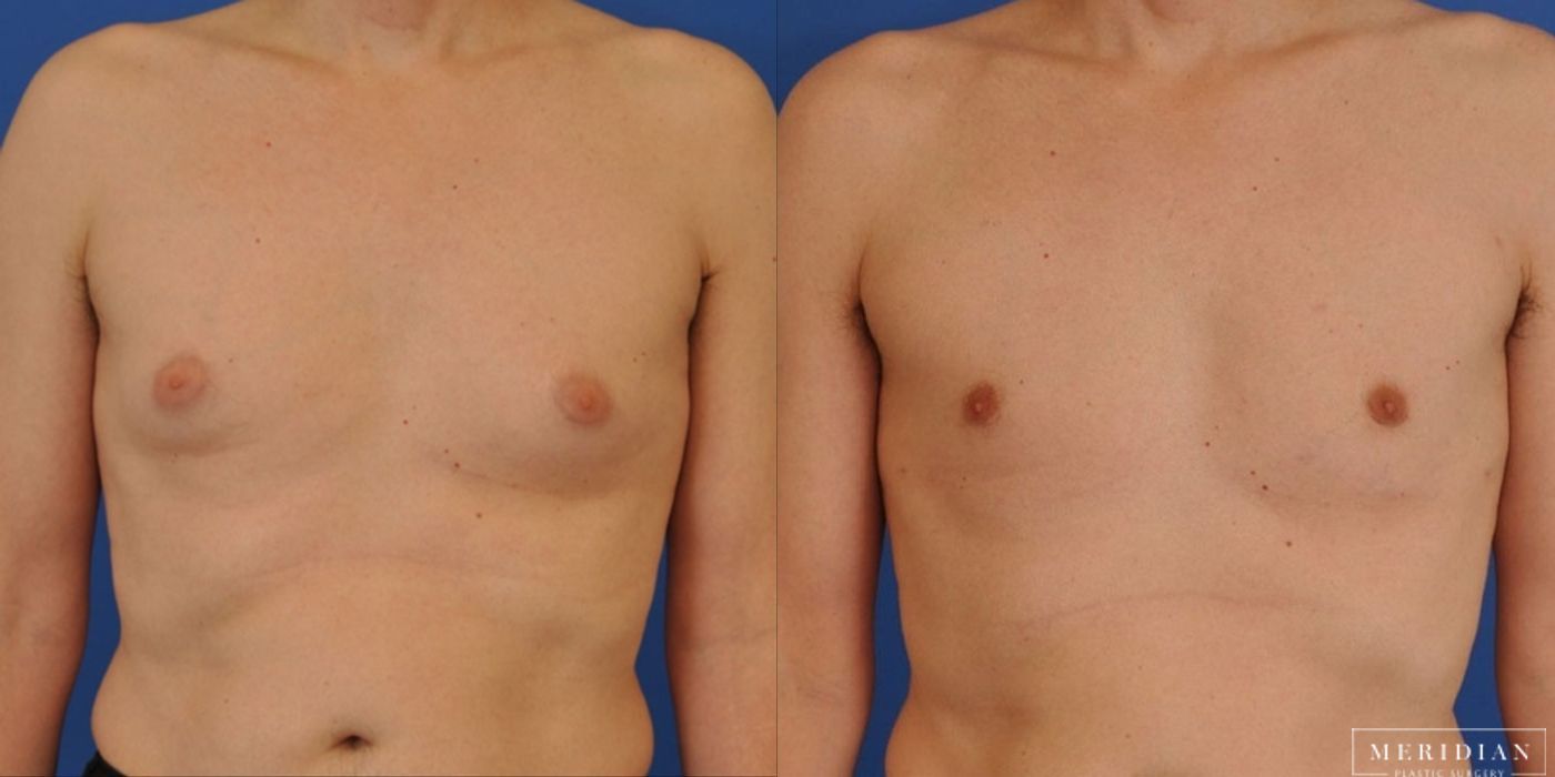 Gynecomastia - Case 8587
