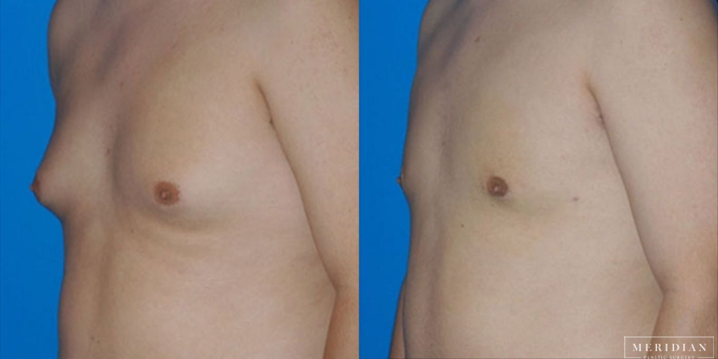 Gynecomastia - Case 8584