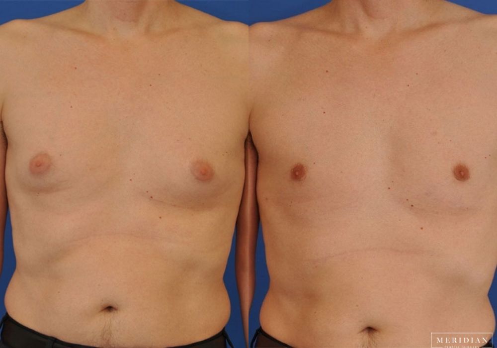 Gynecomastia - Case 7908