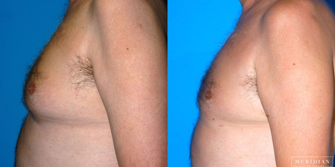 Gynecomastia - Thumbnail 3