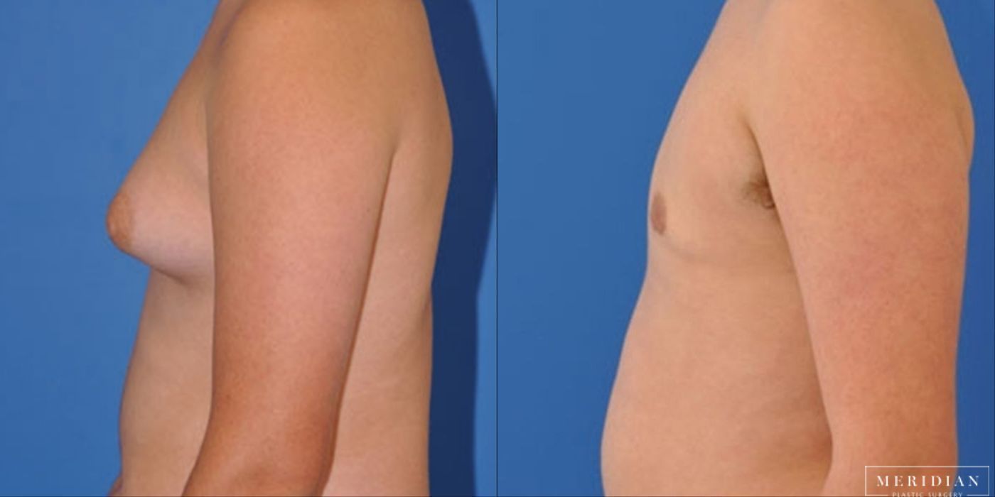 Gynecomastia - Case 8585