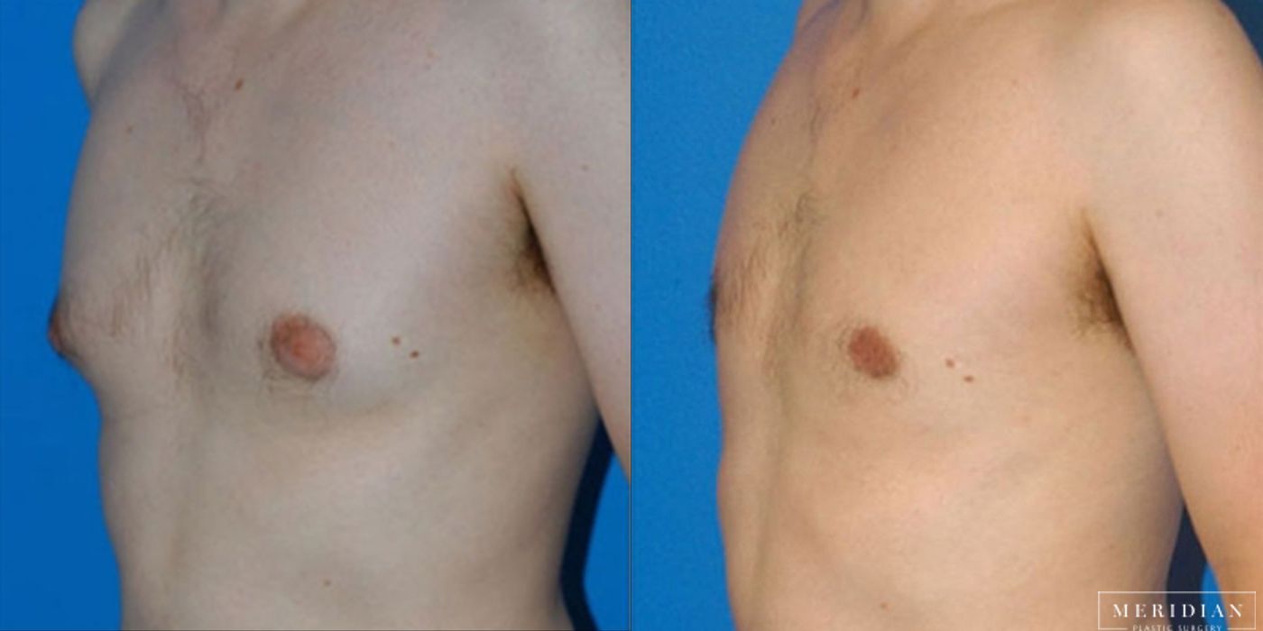 Gynecomastia - Case 8583