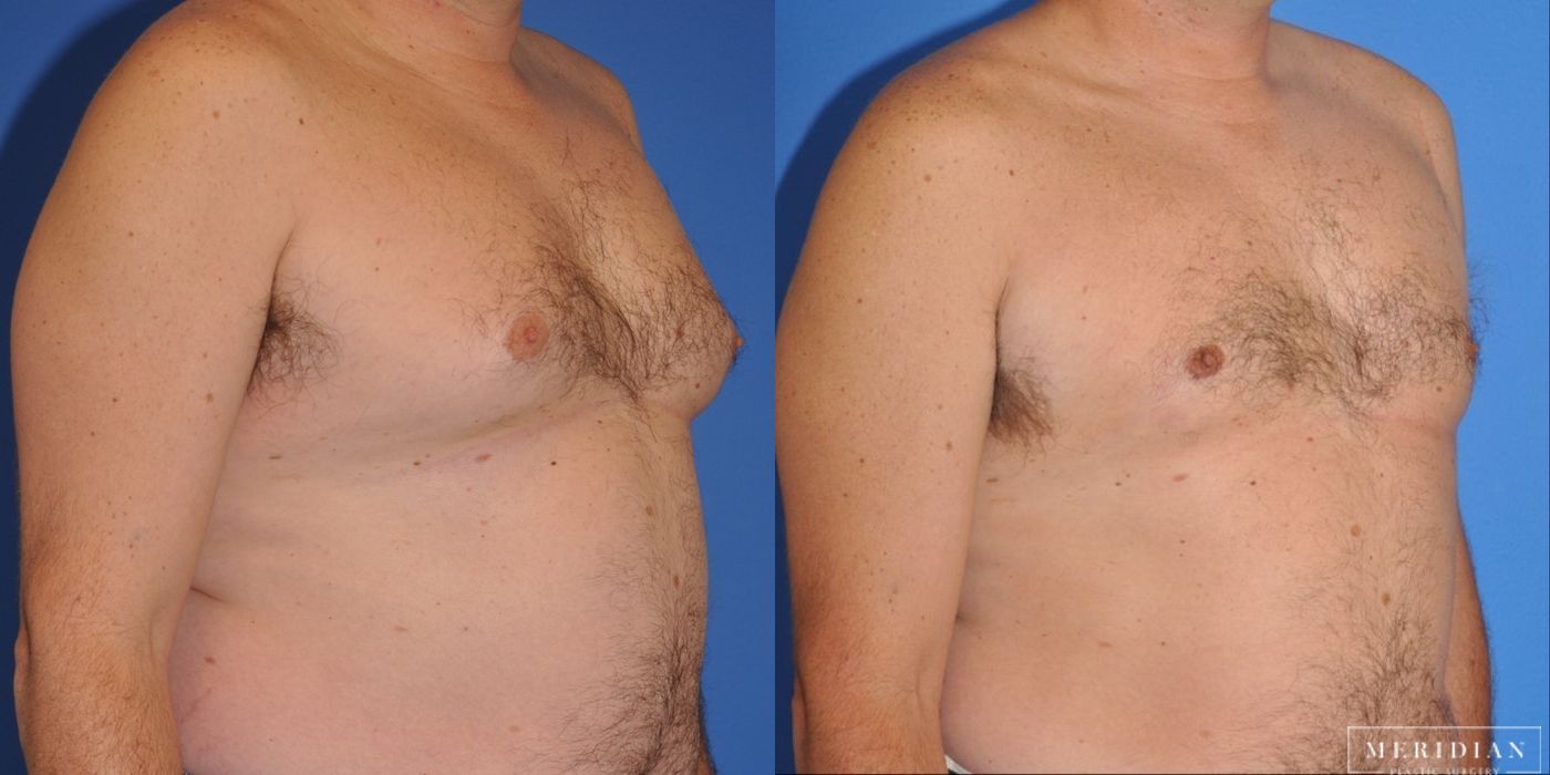 Gynecomastia - Thumbnail 2