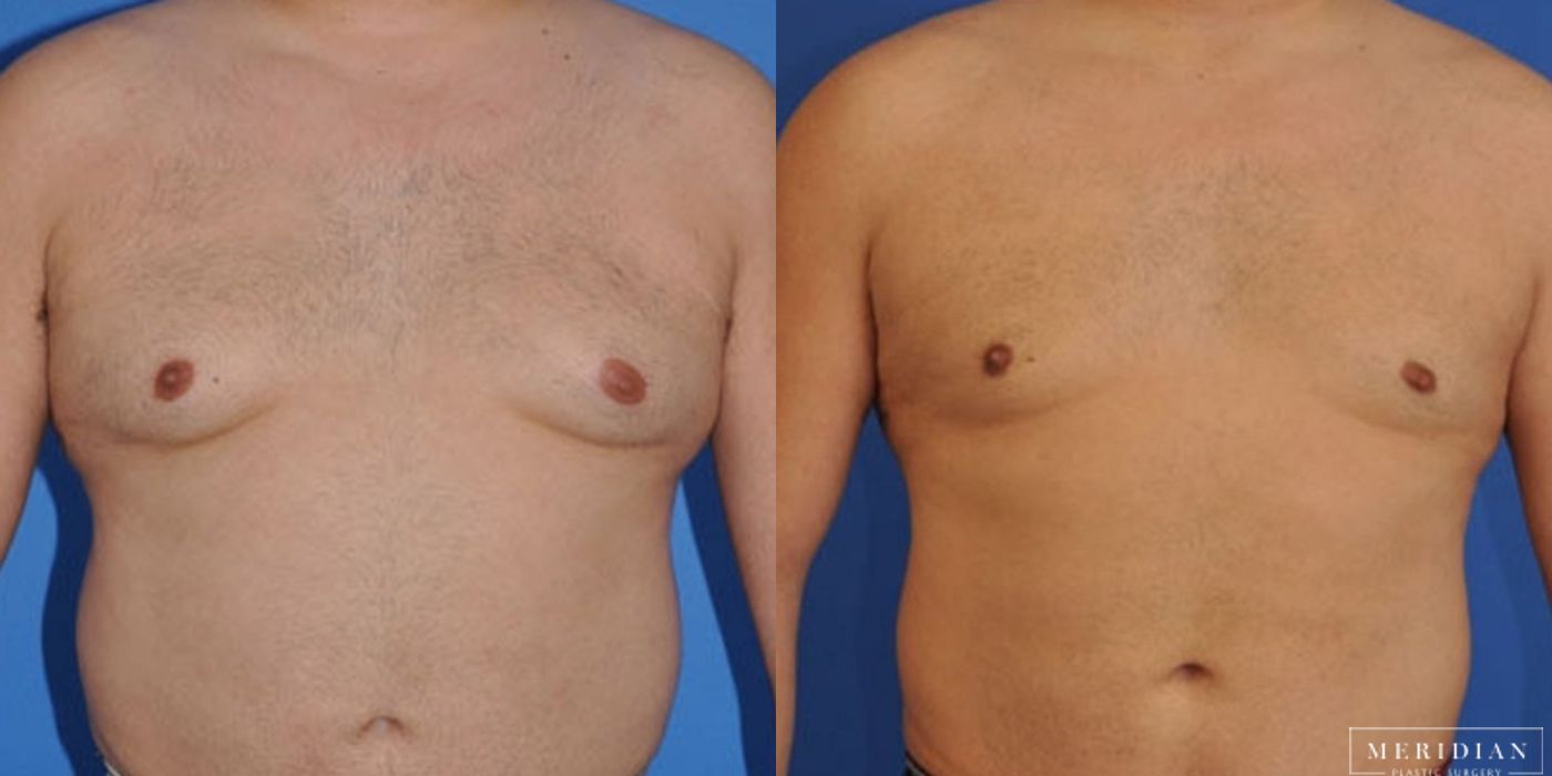 Gynecomastia - Case 8586