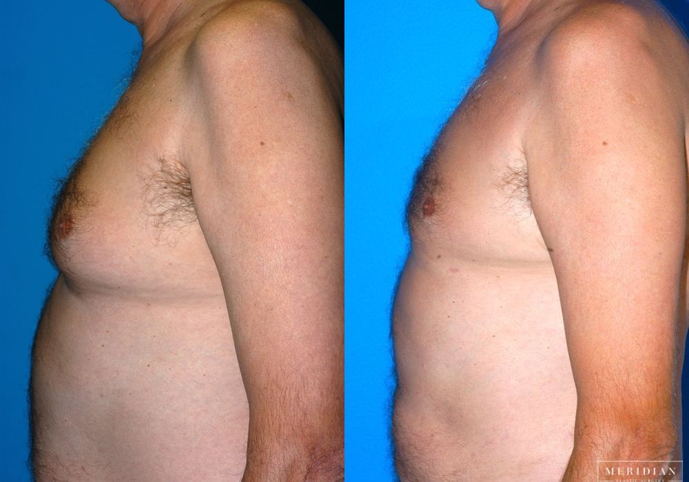 Gynecomastia - Thumbnail 3