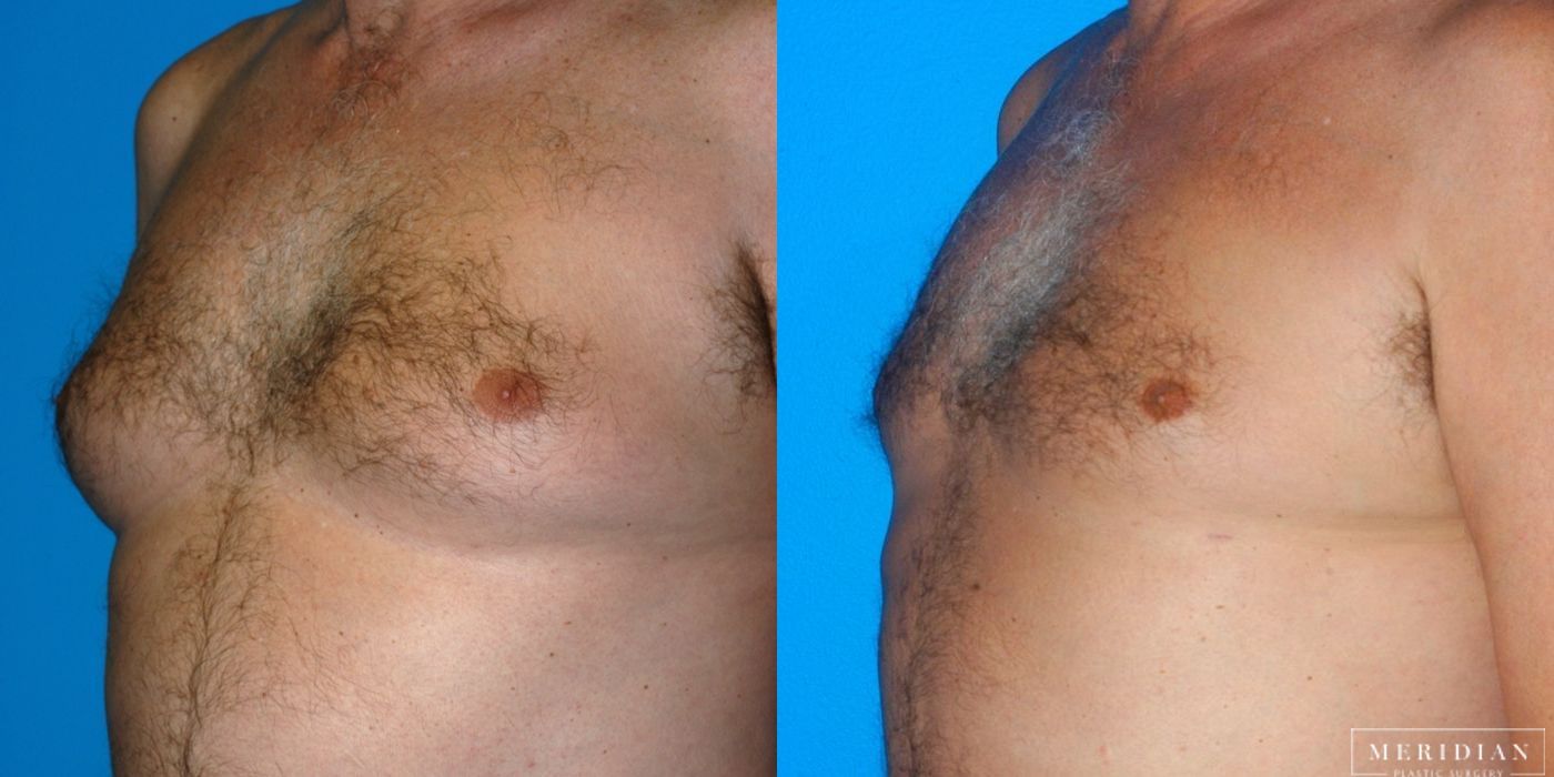 Gynecomastia - Thumbnail 2