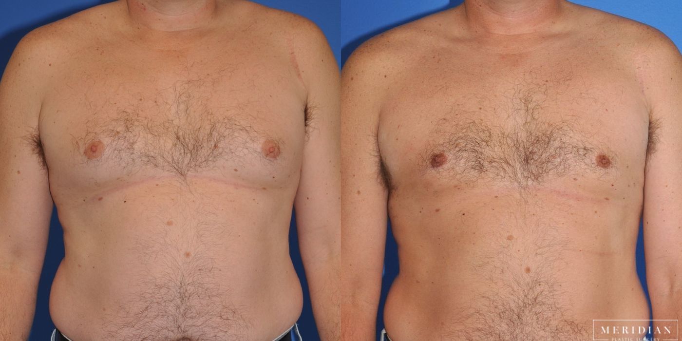 Gynecomastia - Case 8579