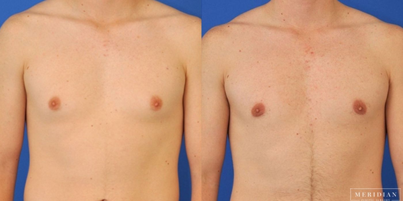 Gynecomastia - Thumbnail 2