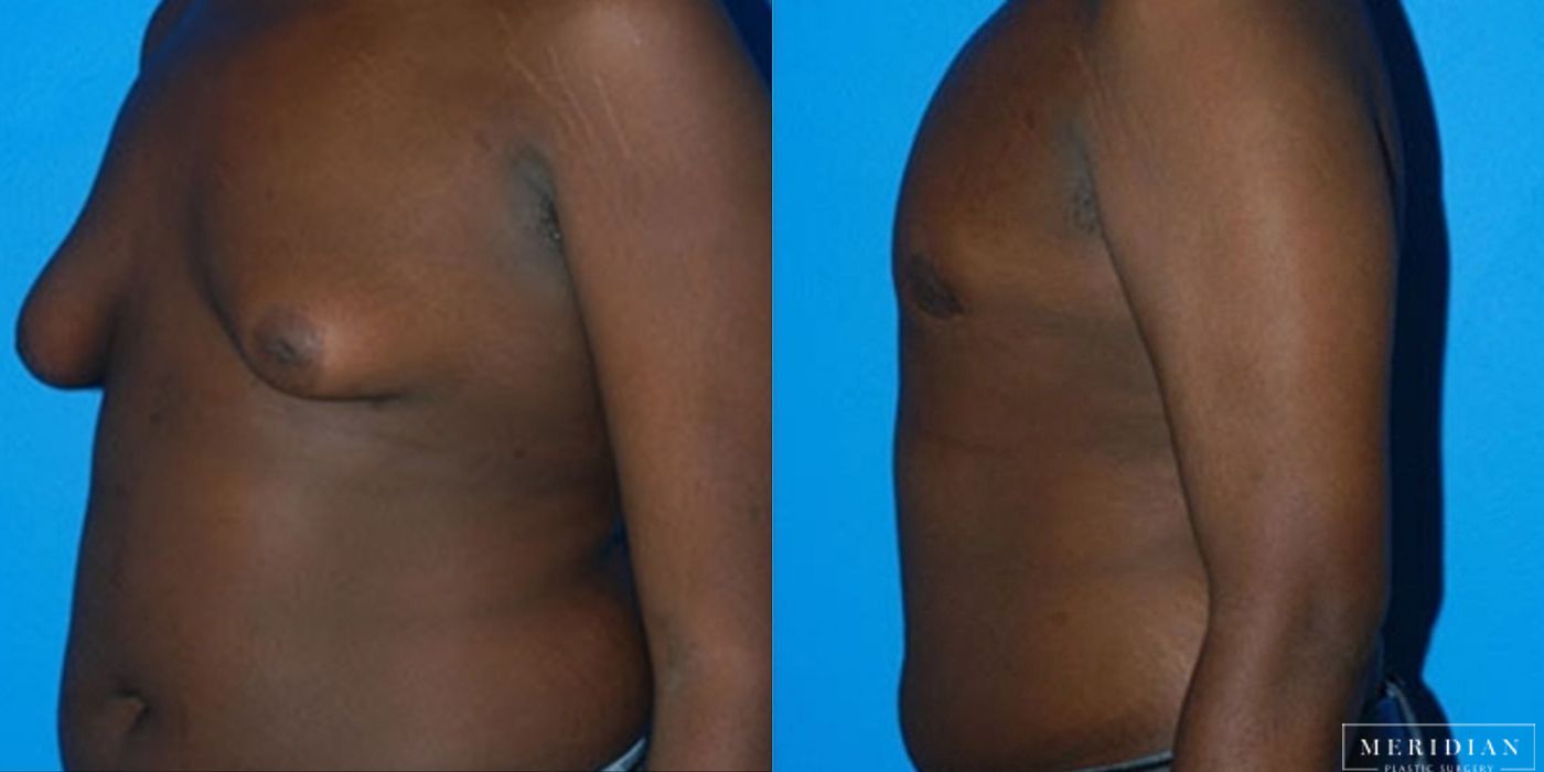 Gynecomastia - Thumbnail 2