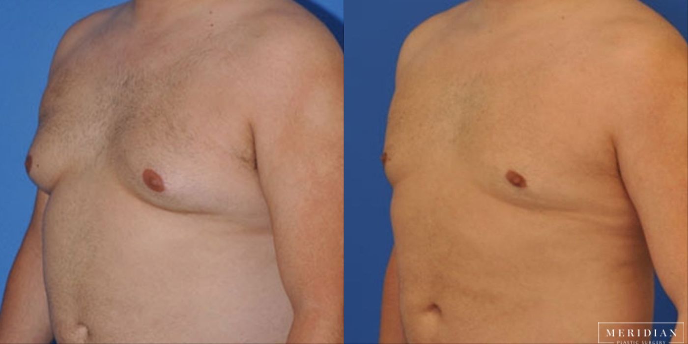 Gynecomastia - Thumbnail 2