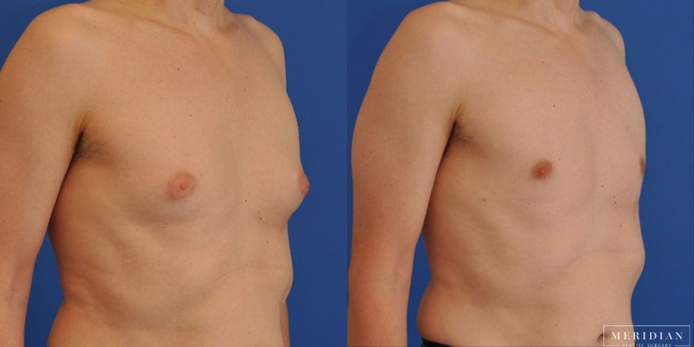 Gynecomastia - Thumbnail 2