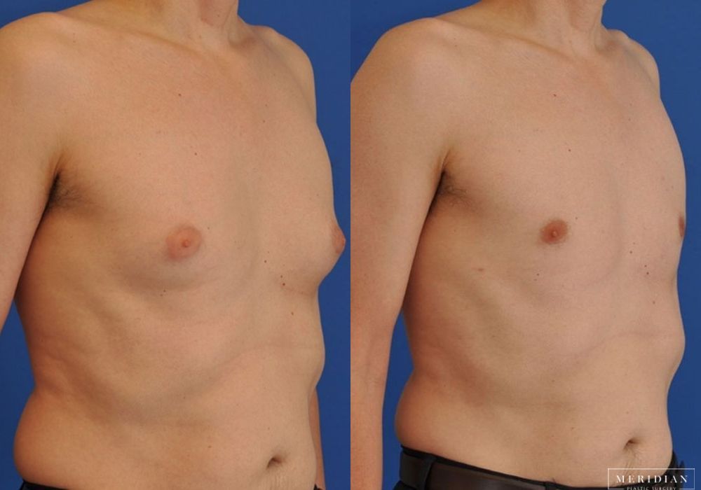 Gynecomastia - Thumbnail 2