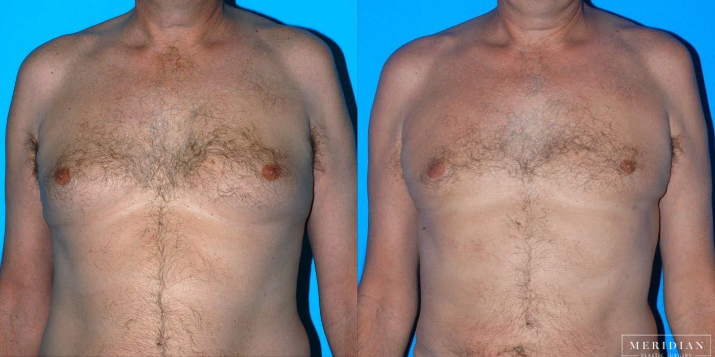 Gynecomastia - Case 8580
