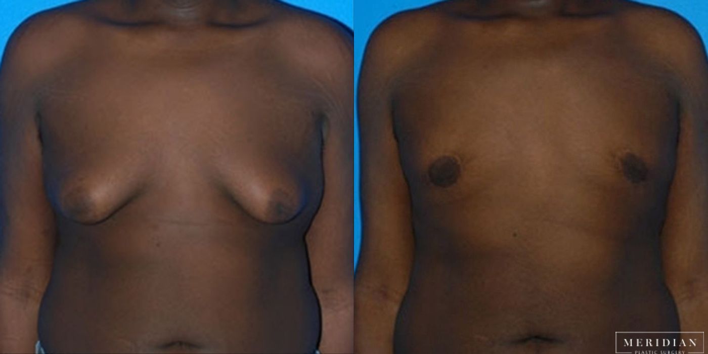 Gynecomastia - Case 8588