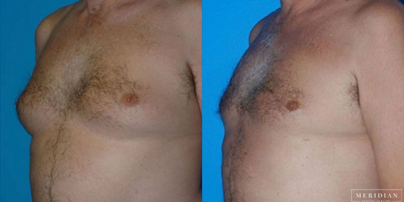 Gynecomastia - Case 8582