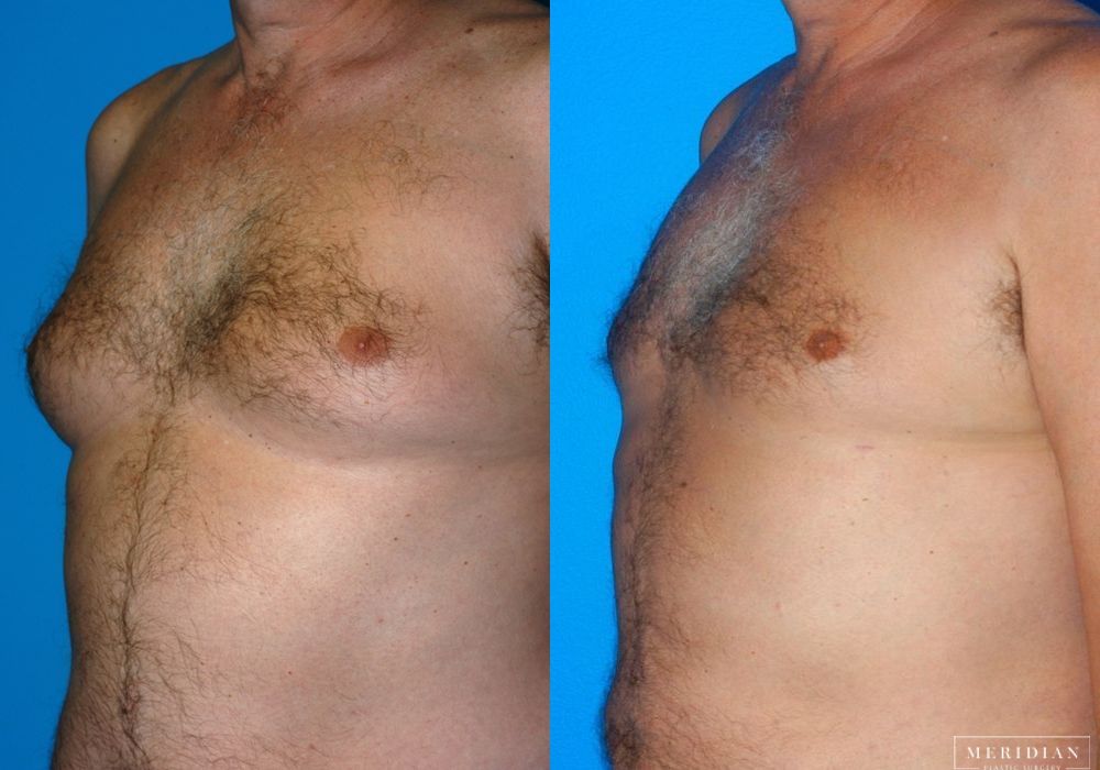 Gynecomastia - Thumbnail 2