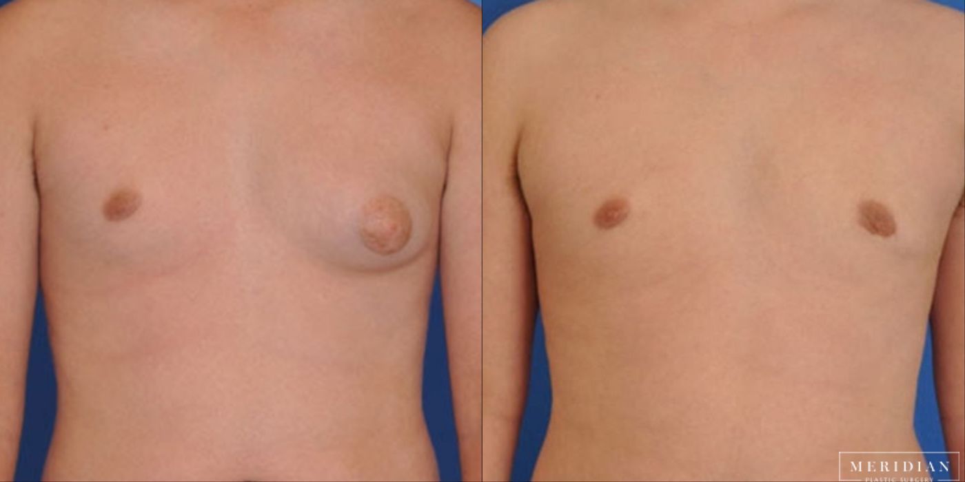 Gynecomastia - Thumbnail 2