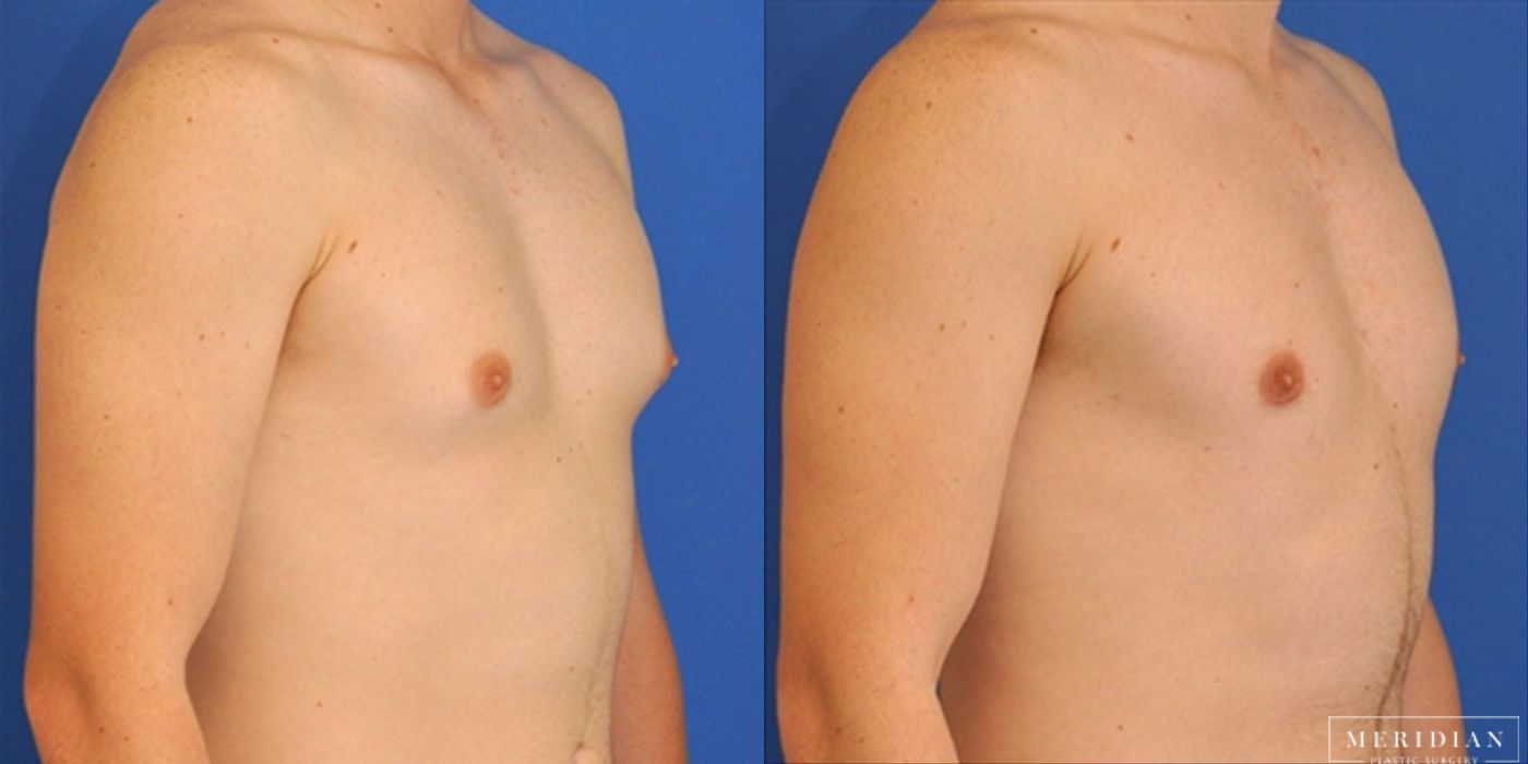 Gynecomastia - Case 8581