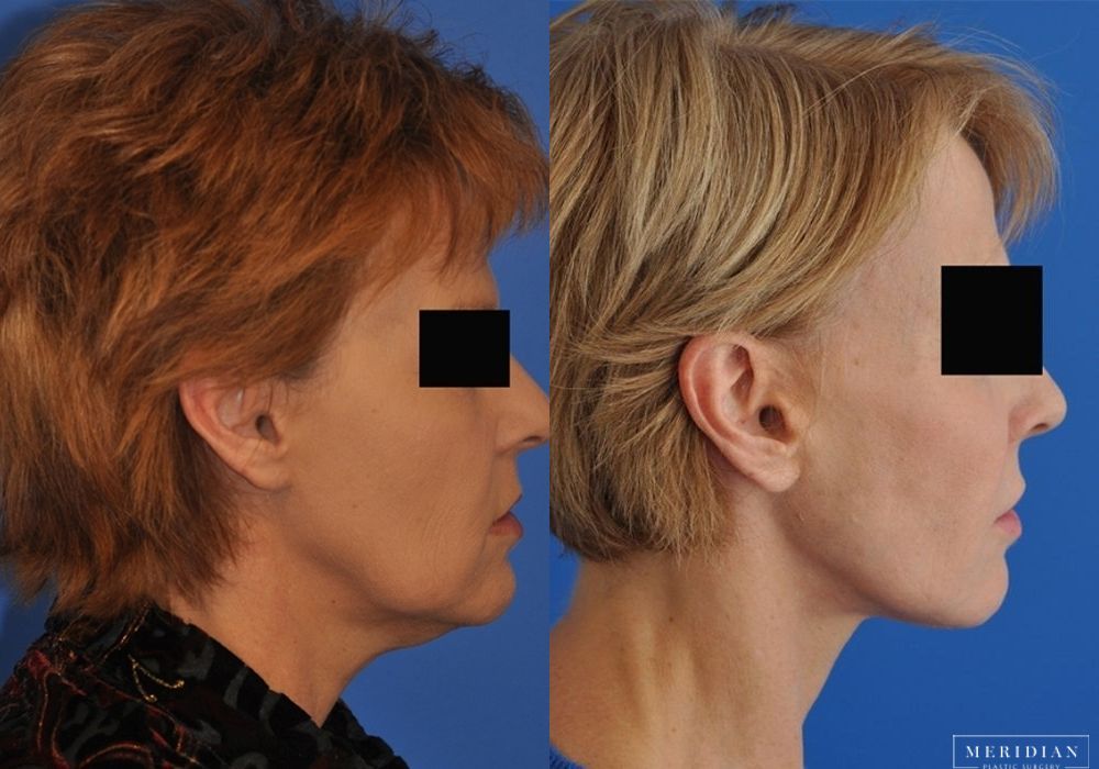 Neck Lift - Thumbnail 3
