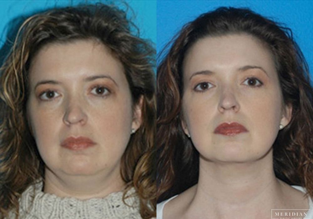 Neck Lift - Case 8127