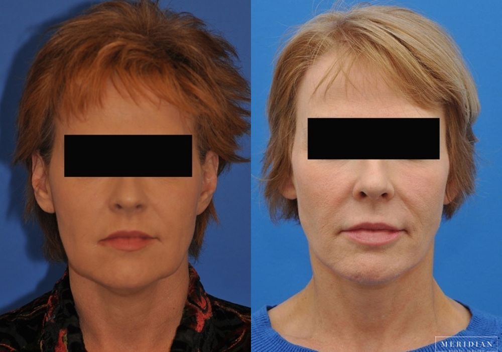 Neck Lift - Case 8131