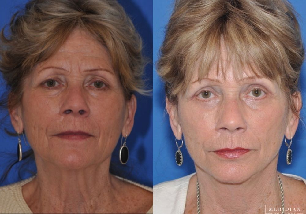 Neck Lift - Case 8129