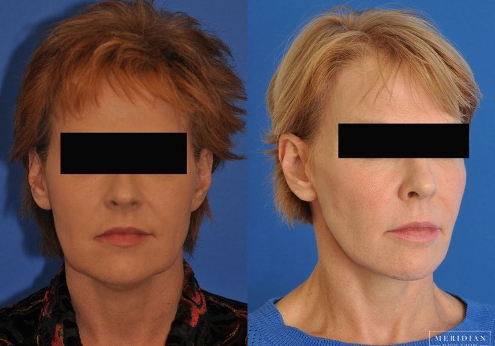 Neck Lift - Thumbnail 2