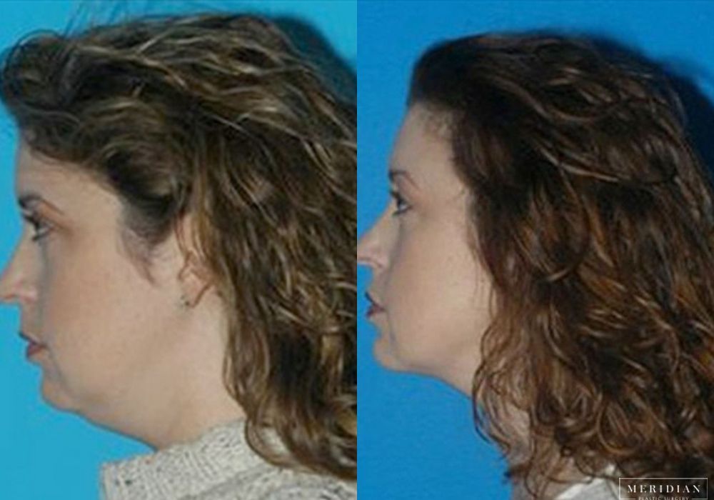 Neck Lift - Thumbnail 2