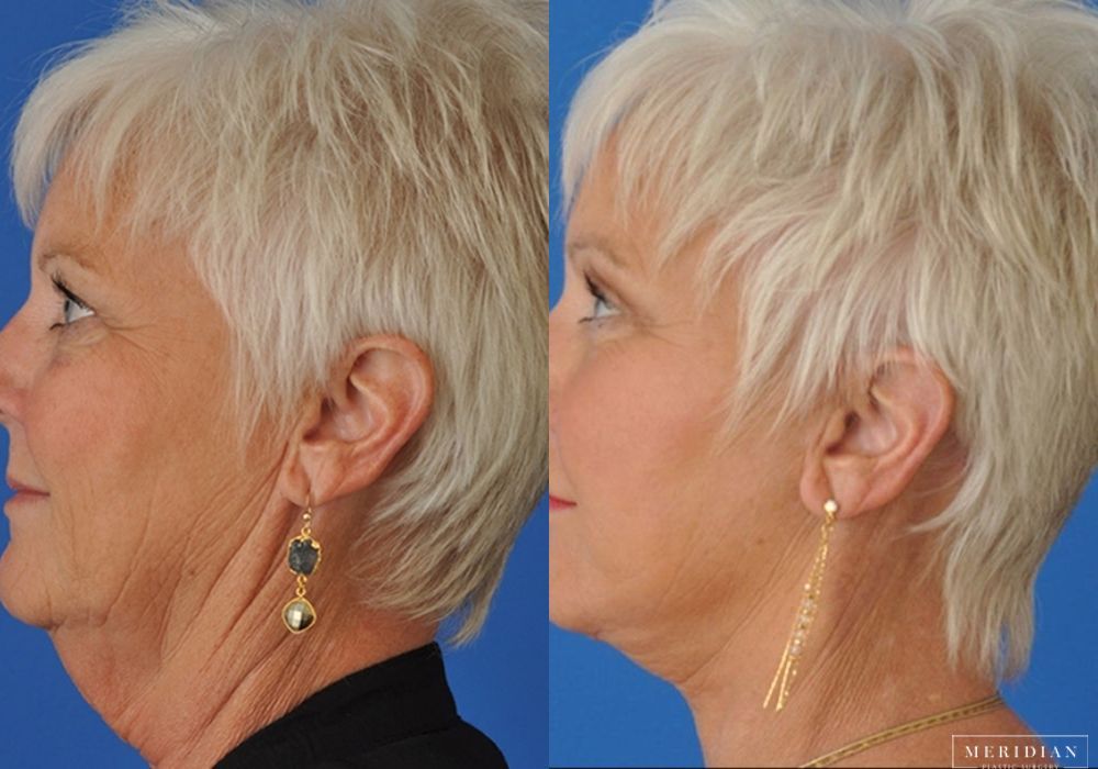 Neck Lift - Thumbnail 3