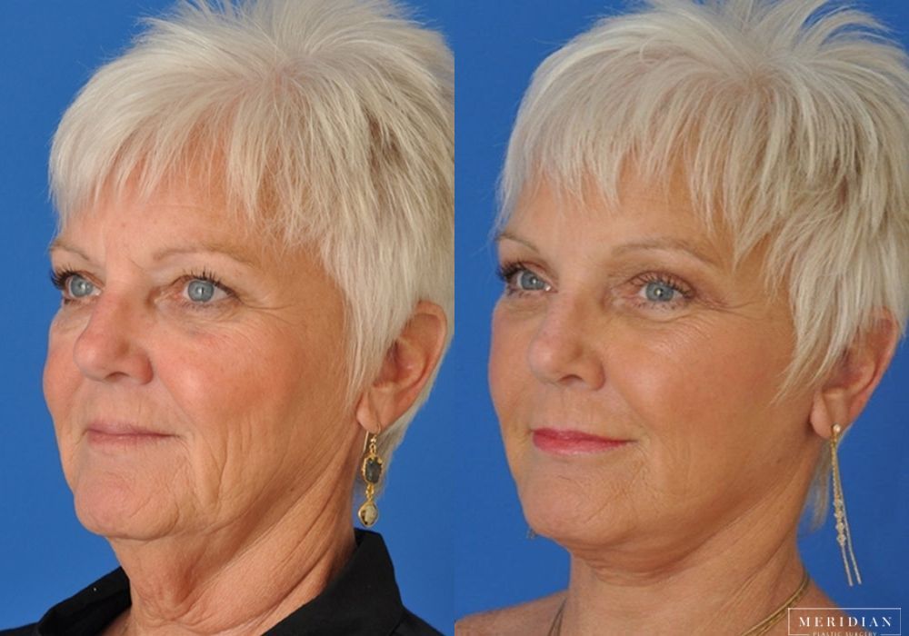 Neck Lift - Thumbnail 2
