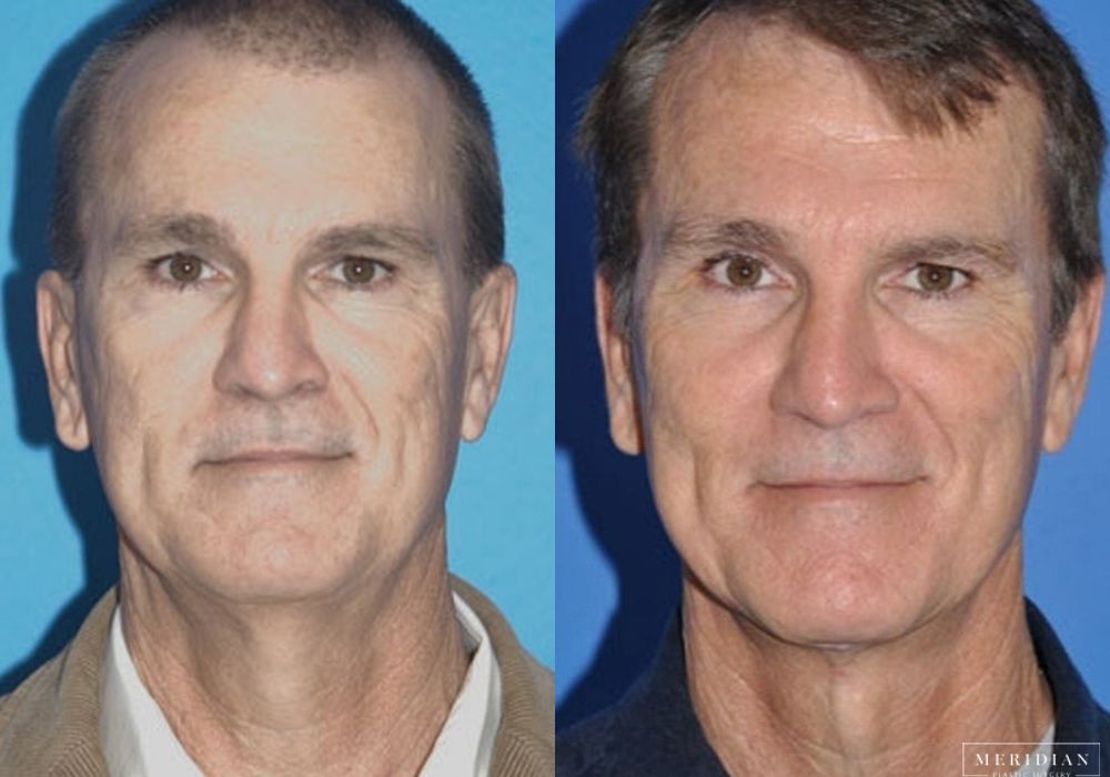 Neck Lift - Case 8132