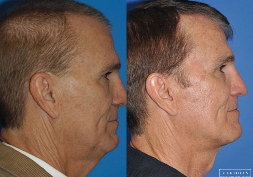 Neck Lift - Thumbnail 2
