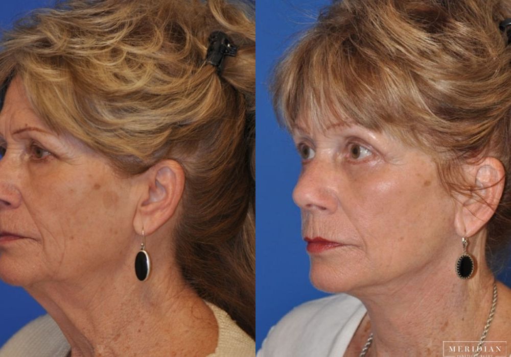 Neck Lift - Thumbnail 2