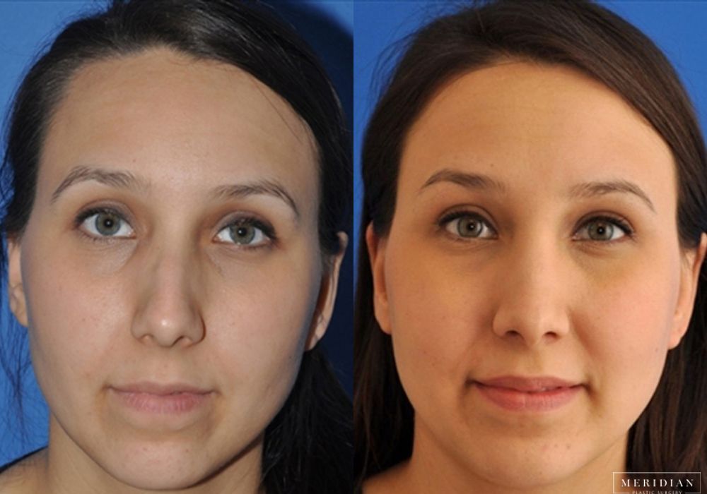 Rhinoplasty - Case 7950