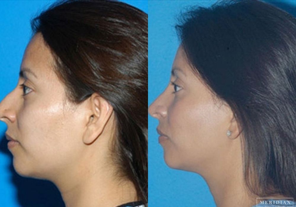 Rhinoplasty - Thumbnail 2