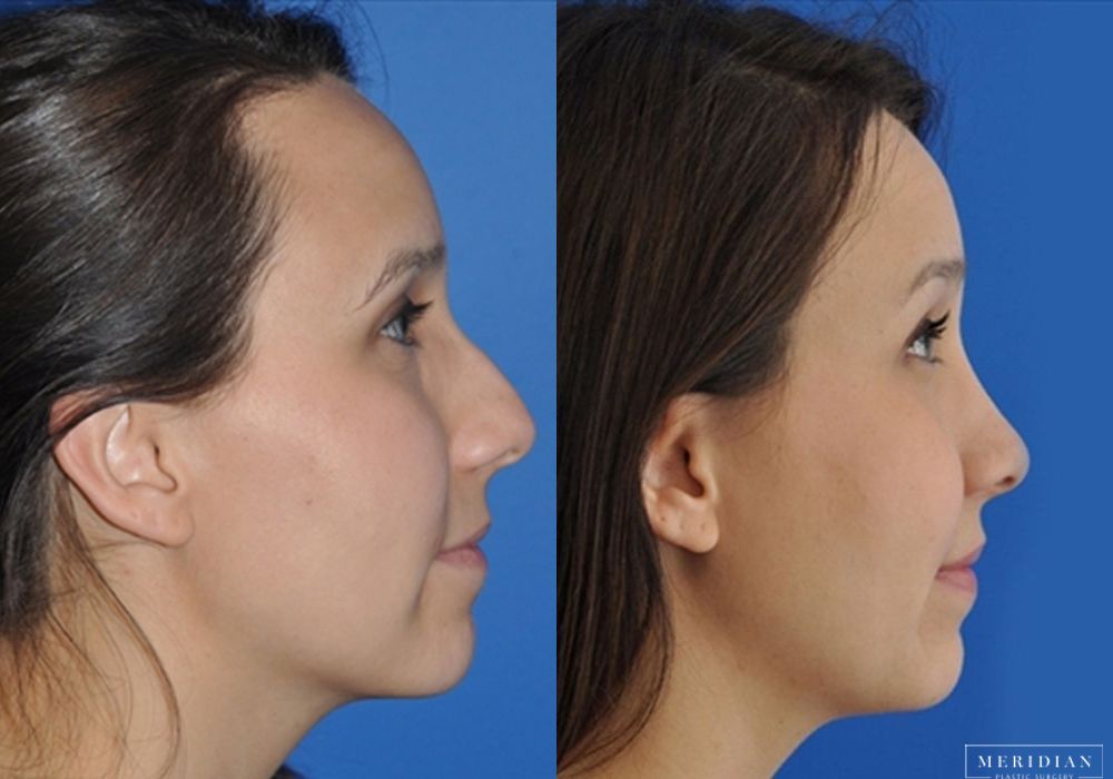 Rhinoplasty - Thumbnail 2