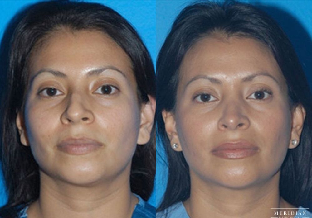 Rhinoplasty - Case 7949