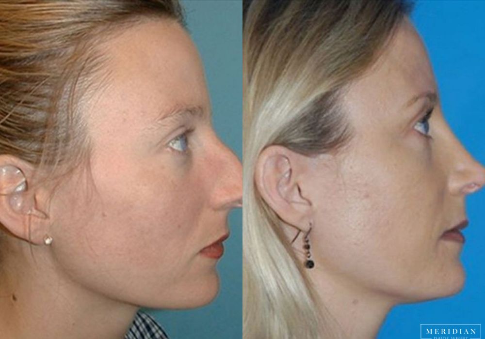 Rhinoplasty - Thumbnail 2