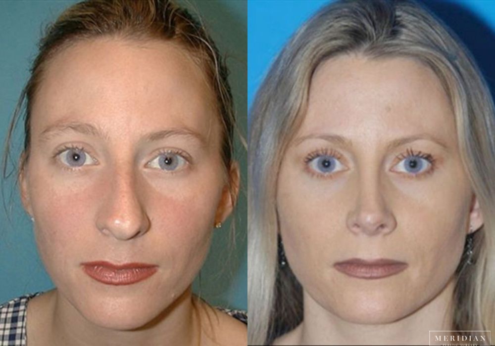 Rhinoplasty - Case 7948