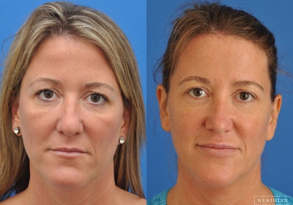 Rhinoplasty - Case 7951