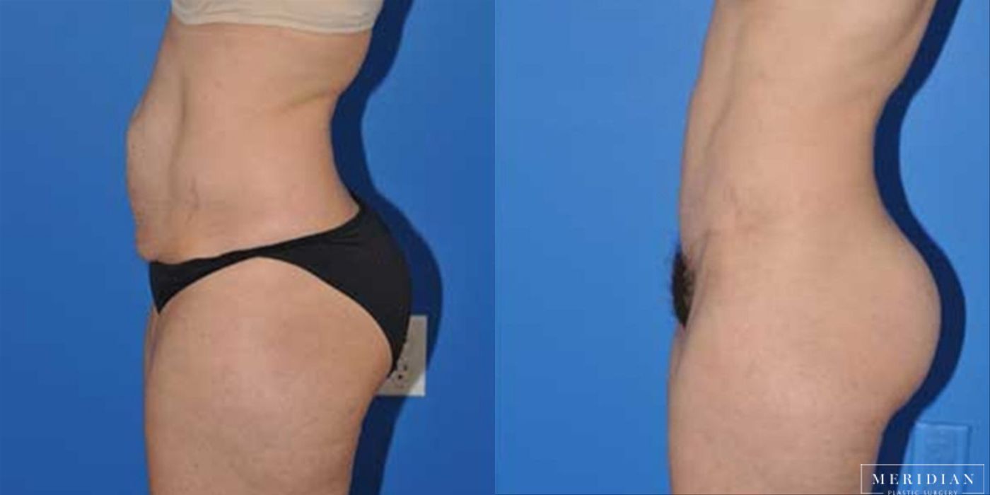 Tummy Tuck - Thumbnail 2